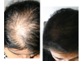 hair-fixing-in-bangalore-hair-fixing-services-hair-fixing-treatment-hair-weaving-services-small-0