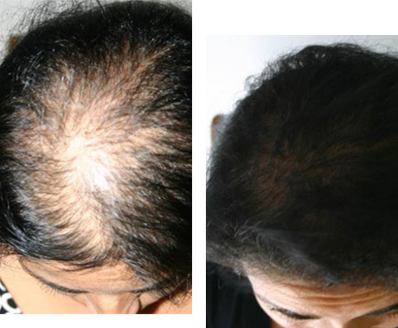 hair-fixing-in-bangalore-hair-fixing-services-hair-fixing-treatment-hair-weaving-services-big-0