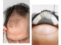 patch-fixing-in-bangalore-hair-patch-fixing-in-bangalore-hair-patch-in-bangalore-small-0