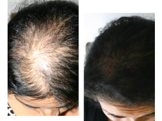 Non-Surgical Hair Replacement in Bangalore-Wigs replacement Center