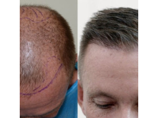 Hair Replacement in Bangalore-Hair Replacement Center