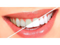 teeth-whitening-dentist-teeth-whitening-cost-bangalore-small-0