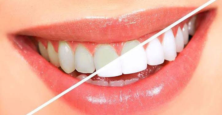 teeth-whitening-dentist-teeth-whitening-cost-bangalore-big-0