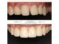 cosmetic-smile-designing-small-3