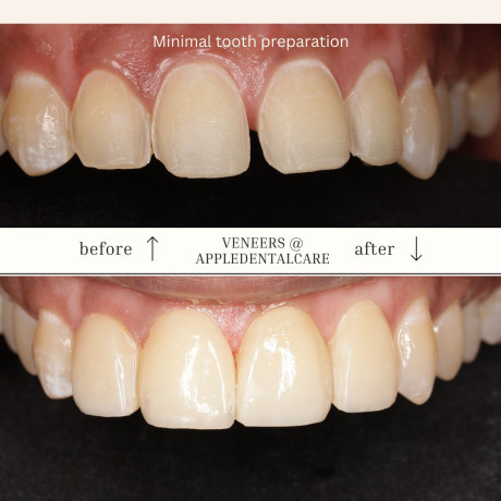 cosmetic-smile-designing-big-3