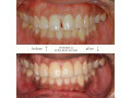 orthodontic-invisalign-small-1