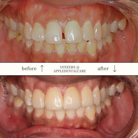 orthodontic-invisalign-big-1