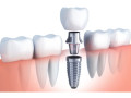 best-dental-hospital-in-bangalore-ridgetop-dental-international-small-0