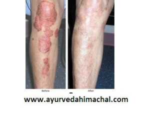 AROGYAM PURE HERBS KIT FOR PSORIASIS