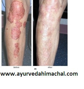 arogyam-pure-herbs-kit-for-psoriasis-big-0