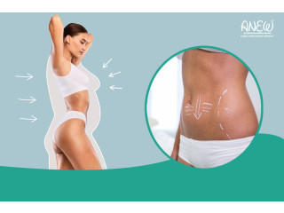 Best Tummy Tuck | Liposuction Clinic in Bangalore at Anew