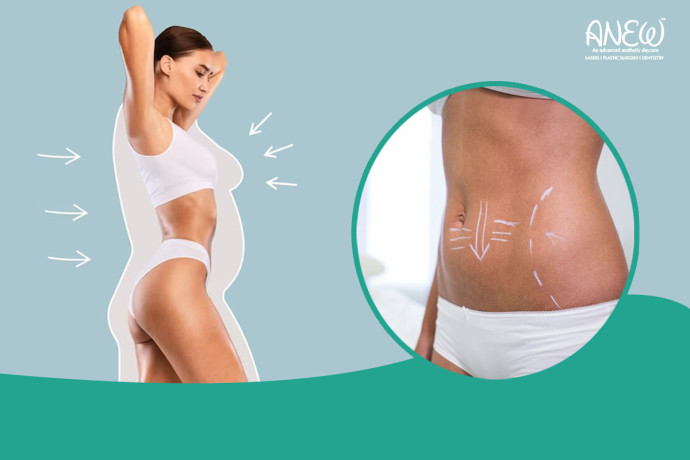 best-tummy-tuck-liposuction-clinic-in-bangalore-at-anew-big-0