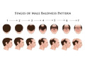 best-hair-transplant-surgery-in-nashik-small-0