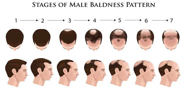 best-hair-transplant-surgery-in-nashik-big-0