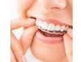 invisalign-braces-cost-in-bangalore-amaya-dental-clinic-small-0