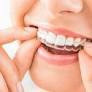 invisalign-braces-cost-in-bangalore-amaya-dental-clinic-big-0