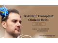 best-hair-transplant-in-delhi-small-0