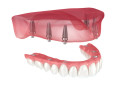 sherman-oaks-dentist-orthodontist-affordable-dental-implants-small-0