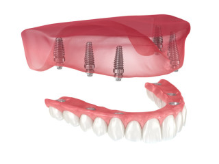 Sherman Oaks Dentist, Orthodontist - Affordable Dental Implants