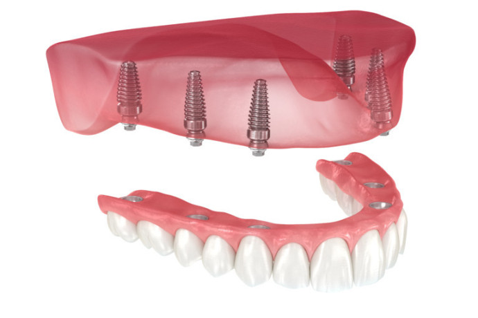 sherman-oaks-dentist-orthodontist-affordable-dental-implants-big-0